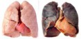 /album/fotogaleria/el-enfisema-es-un-tipo-de-enfermedad-pulmonar-obstructiva-cronica-epoc-jpg/